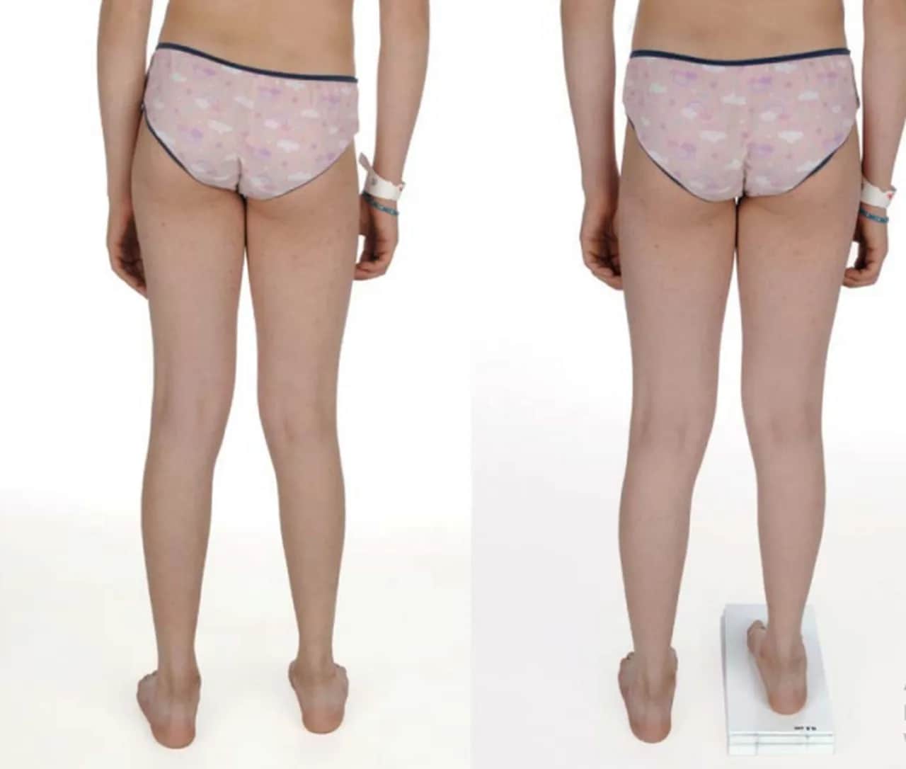 Jedna noga krótsza: przyczyny, objawy i skuteczne leczenie